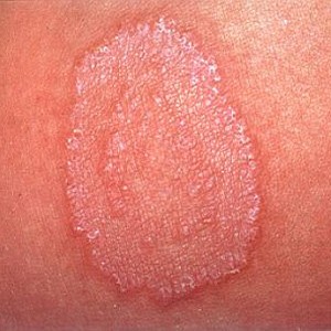 Healing Ringworm