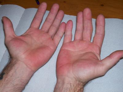 RE: Excessive Sweating - Red Hands