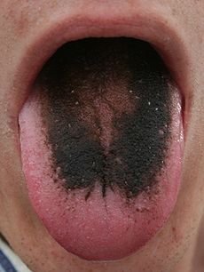RE: Uses For Hydrogen Peroxide