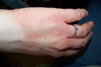 Top of Hands Are Red