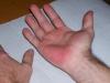 RE: Excessive Sweating - Red Hands