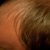 Man With Thinning Greasy Hair