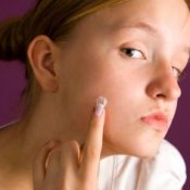 Woman applying acne cream to her face.