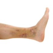 Remedies for Bruises, Bruised Ankle