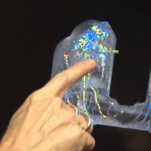 Breast Cancer Detection and Prevention