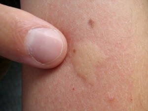 Spider Bites Look Like Ringworm