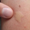 Mosquito Bite Remedies