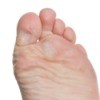 Foot Calluses