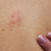 Shingles