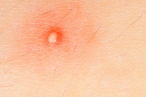 Skin Boil