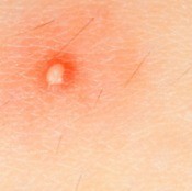 Skin Boil