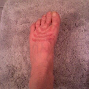 Top Of Foot Itchy Red Rash