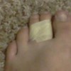 Foot with two toes taped together