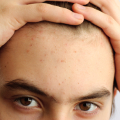 Teenager Holding His Hair Up to Show Acne on Forehead