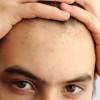 Teenager Holding His Hair Up to Show Acne on Forehead