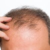 Remedies For Hair Loss, Man Touching His Balding Head
