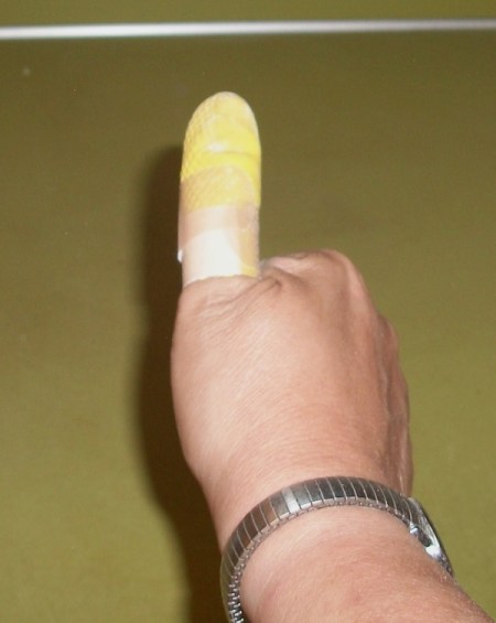 Thumb bandaged with rubber glove tip