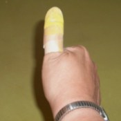 Thumb bandaged with rubber glove tip