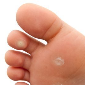 Foot wart nail polish. Idei de încercat on Pinterest