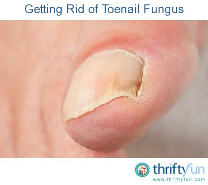 Toenail fungus pictures white - Awesome Nail