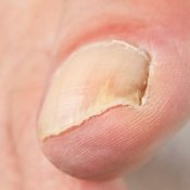 Photo of a toe with toenail fungus.