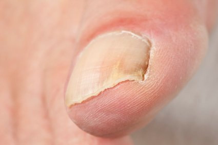 fungal-nail-infection-jama-2017-317-5-546-doi-10-1001-jama-2016