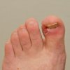 A foot with an ingrown toenail.