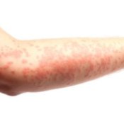 Arm With Hives