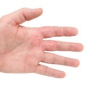 Hand with eczema rash