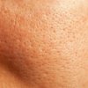 Closeup of Facial Pores and Oily Skin