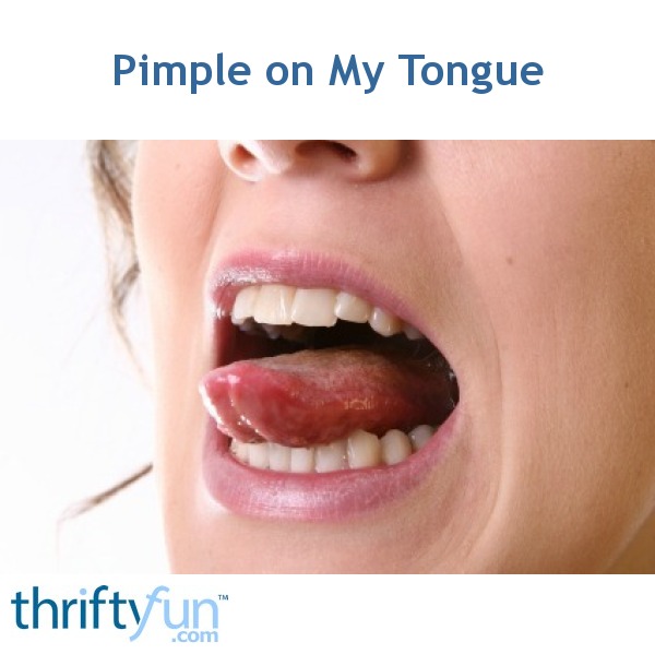 "Pimple" on My Tongue | ThriftyFun
