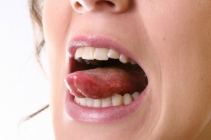 A woman with a pimple on her tongue.