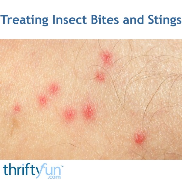 Treating Insect Bites and Stings | ThriftyFun
