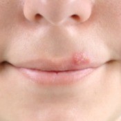 Remedies for Cold Sores