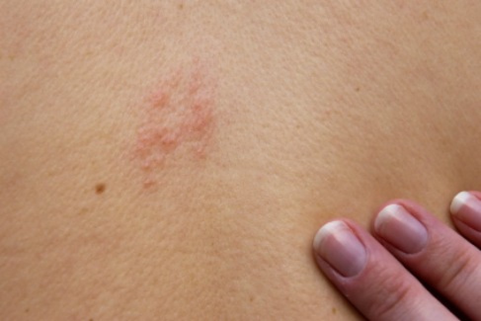 Does Shingles Cause Nerve Pain