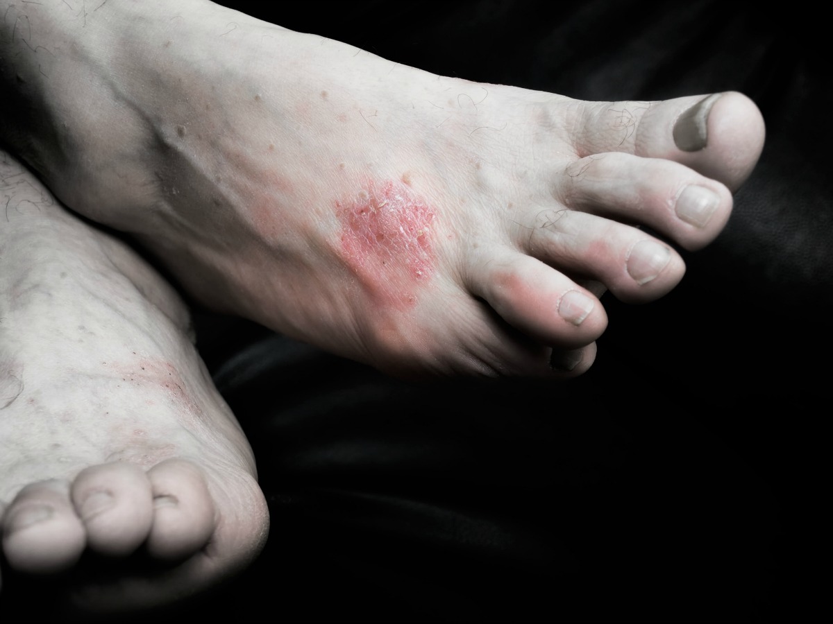 sides of feet itch