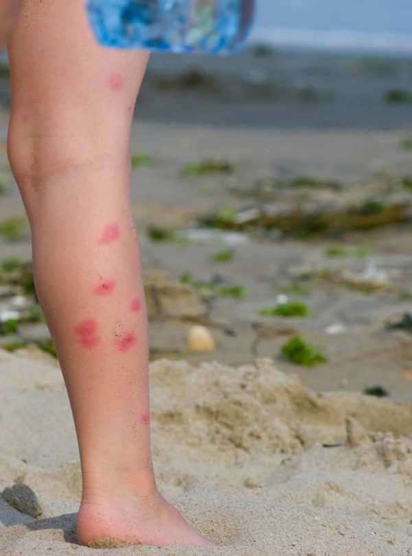 sand flea bites mosquito bite skin bug fleas fly treatment children spots bit young insect florida bugs humans child leg
