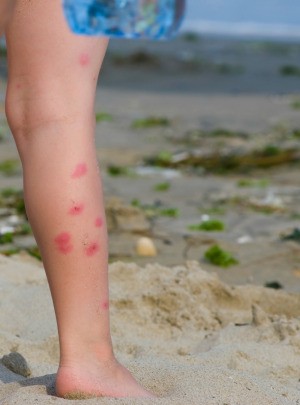 Mosquito bites on a young child.