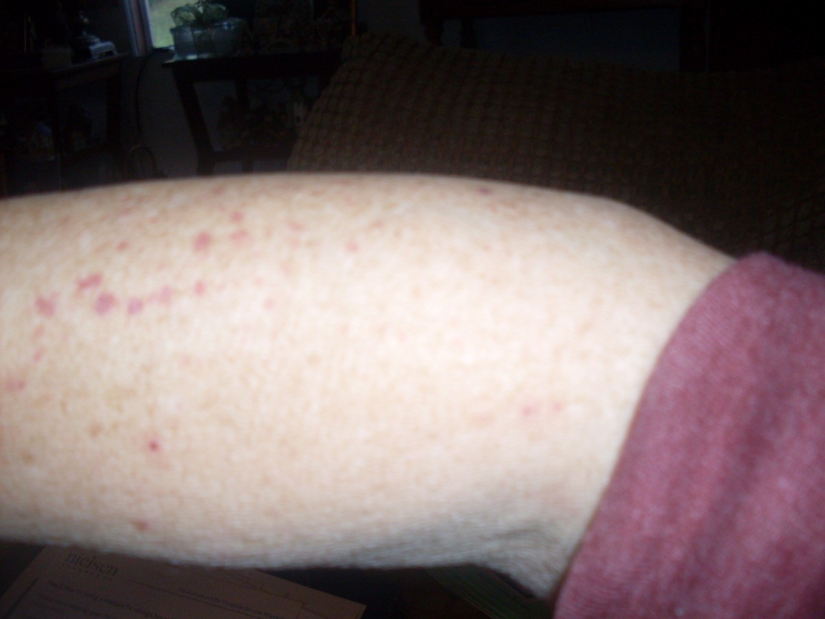 Identifying Red Spots on Arm? ThriftyFun