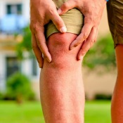 Man with Arthritis in His Knee
