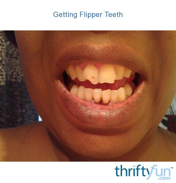 Getting Flipper Teeth | ThriftyFun