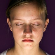 young girl with facial blemishes, eyes closed