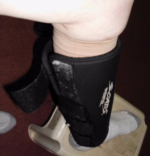 Preventing Leg Ulcers with Shin Guards