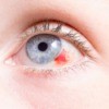 A blue eye with a red injury.