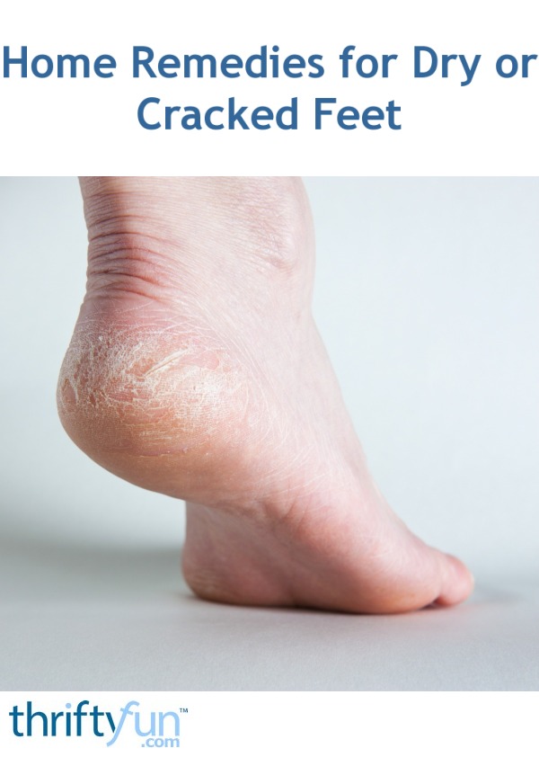 dry flaky feet home remedies