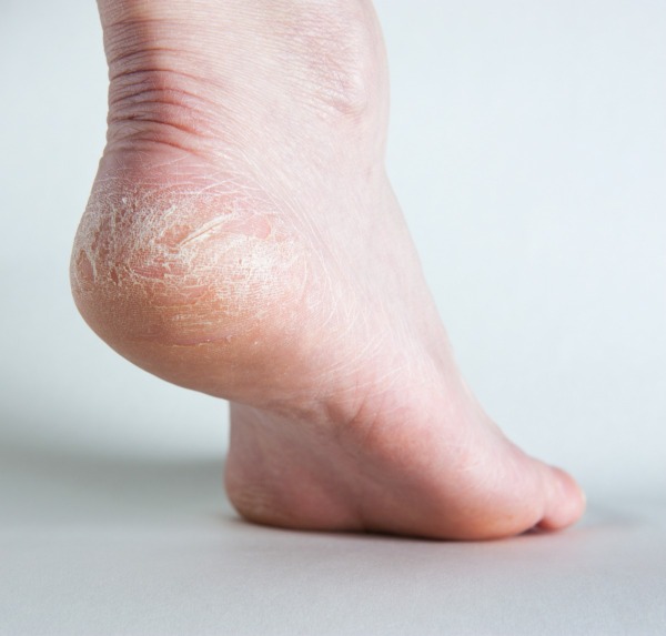 Why Do You Get Dry Skin On Your Feet