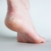 dry heel on foot