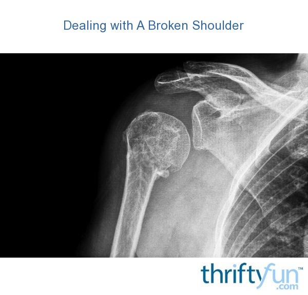 Dealing with A Broken Shoulder ThriftyFun