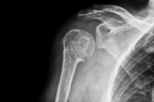 Dealing with A Broken Shoulder