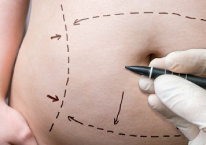 Close up of belly with pen marking plastic surgery lines